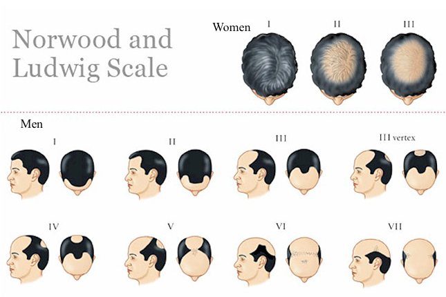 Quels résultats peut-on attendre avec la greffe de cheveux?